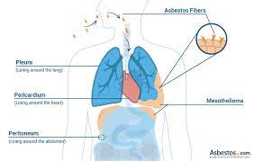 How Doctors cure Mesothelioma Disease?